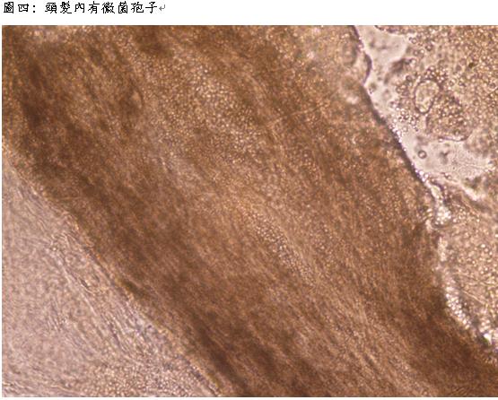 頭皮發炎與疼痛小心頭癬