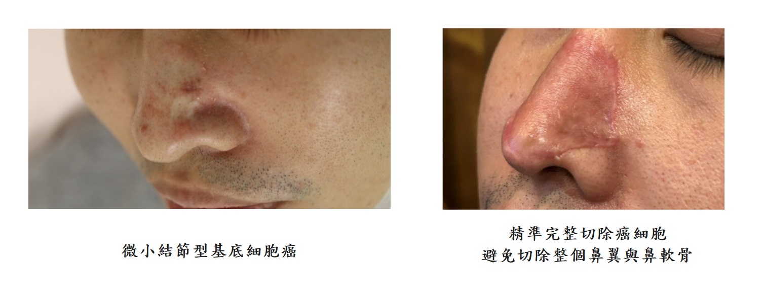 微小結節型基底細胞癌及精準完整切除癌細胞,避免切除整個鼻翼與鼻軟骨的圖片