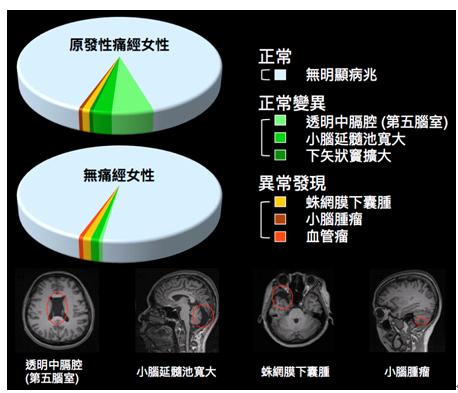 原發性痛經之基因學及腦造影研究