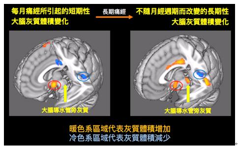 原發性痛經之基因學及腦造影研究