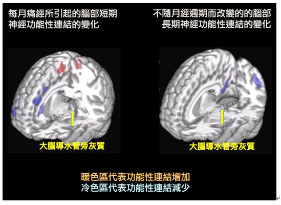 原發性痛經之基因學及腦造影研究