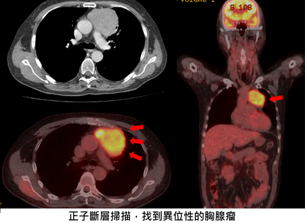 正子斷層掃描，找到異位性的胸腺瘤