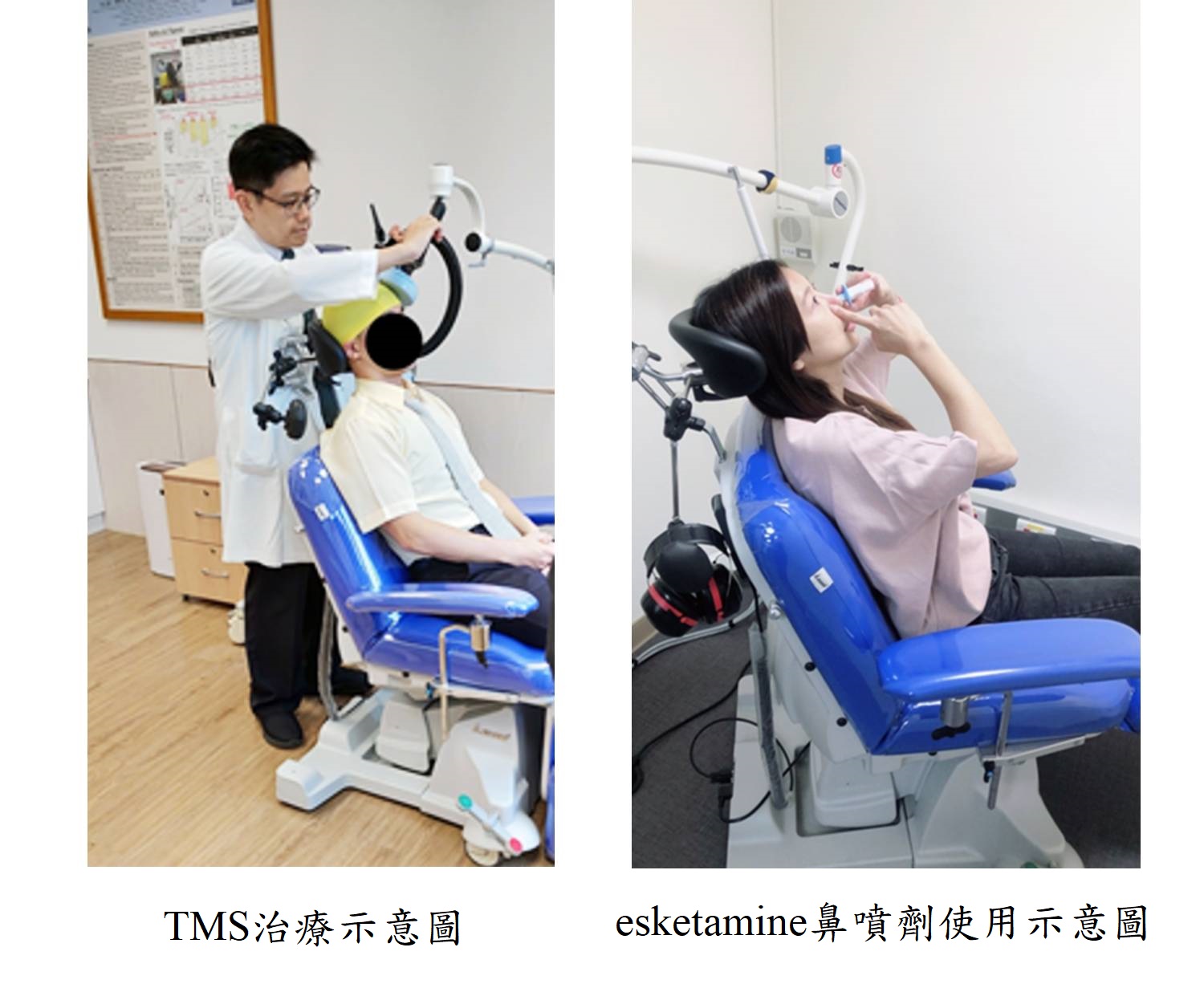 TMS治療示意圖及esketamine鼻噴劑使用示意圖