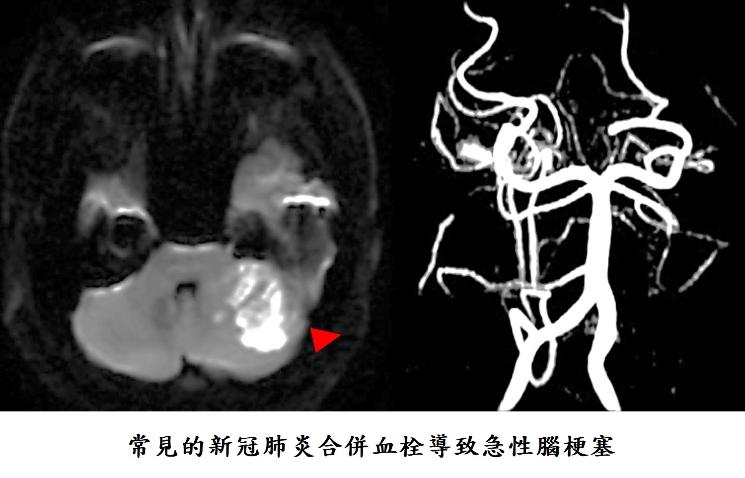 常見的新冠肺炎合併血栓導致急性腦梗塞