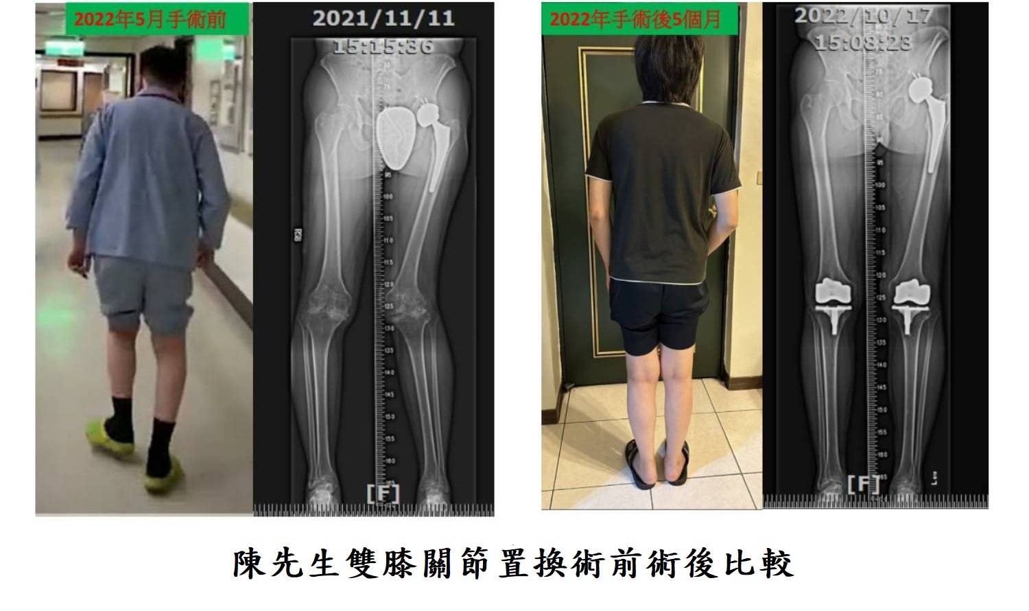 陳先生雙膝關節置換術前術後比較