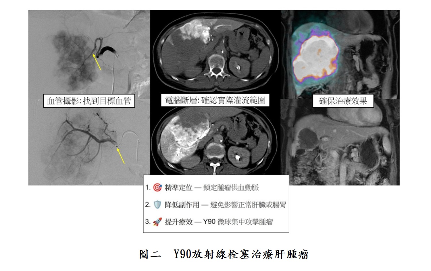 圖二 Y90放射線栓塞治療肝腫瘤