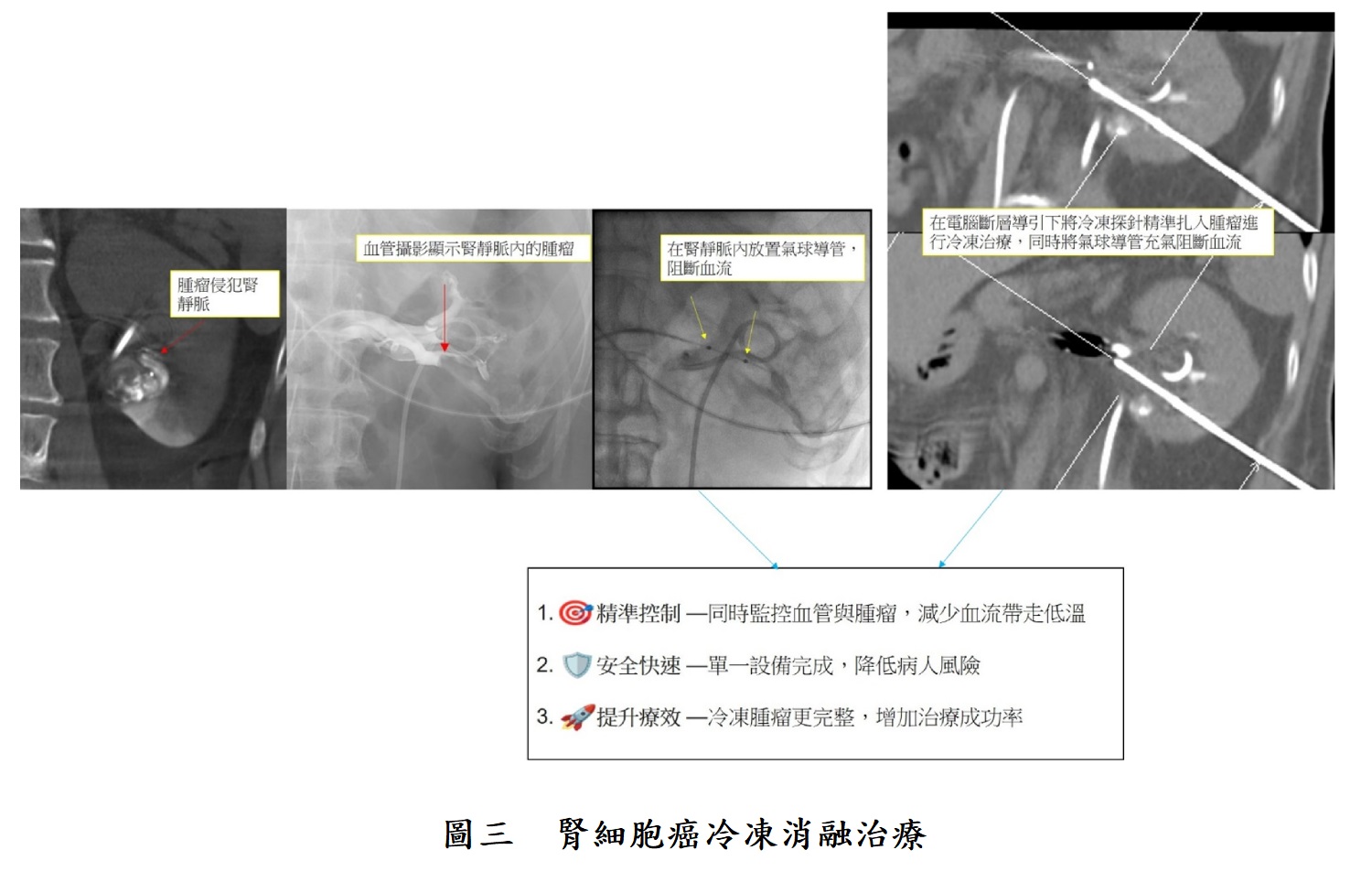 圖三 腎細胞癌冷凍消融治療