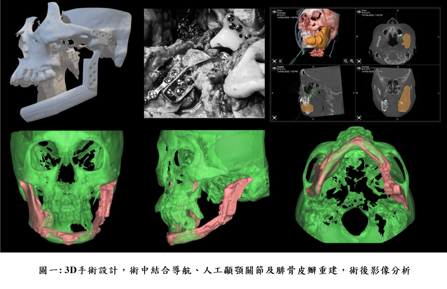 圖一: 3D手術設計,術中結合導航、人工顳顎關節及腓骨皮瓣重建,術後影像分析