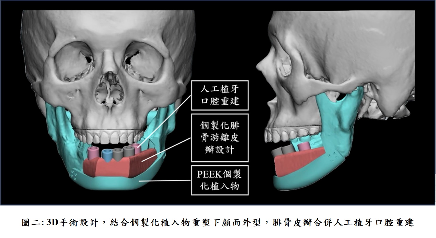 圖二: 3D手術設計,結合個製化植入物重塑下顏面外型,腓骨皮瓣合併人工植牙口腔重建