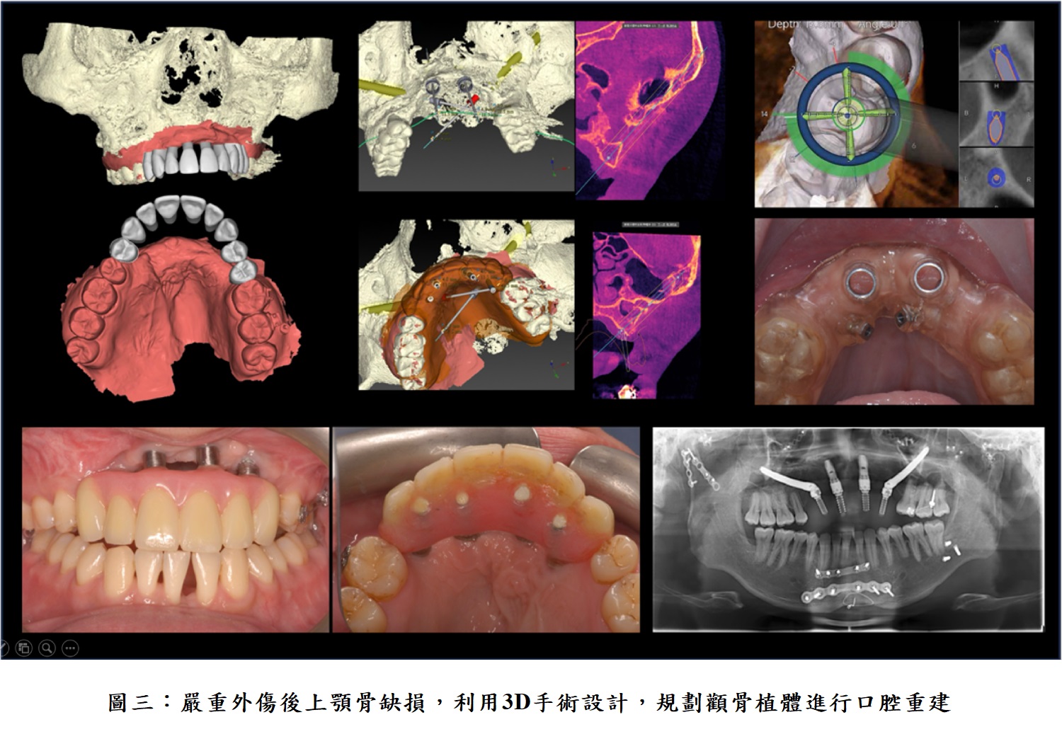 圖三:嚴重外傷後上顎骨缺損,利用3D手術設計,規劃顴骨植體進行口腔重建