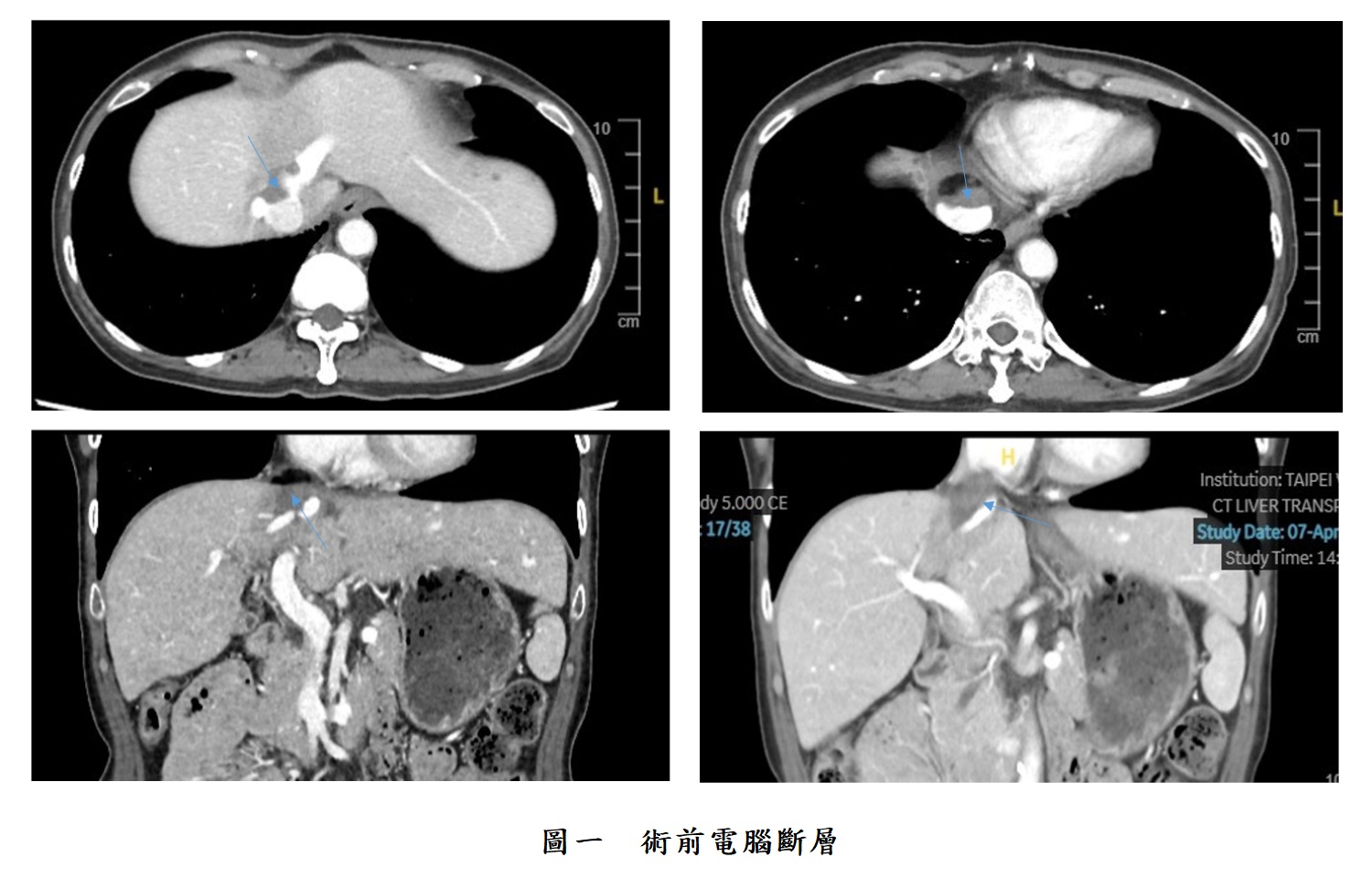 圖一 惡性腫瘤術前電腦斷層