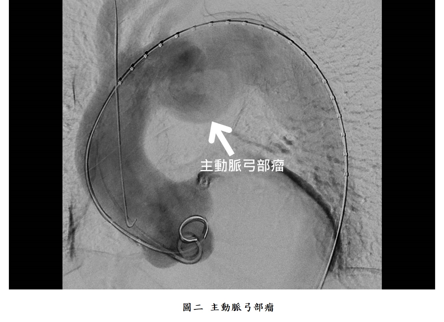 圖二 主動脈弓部瘤