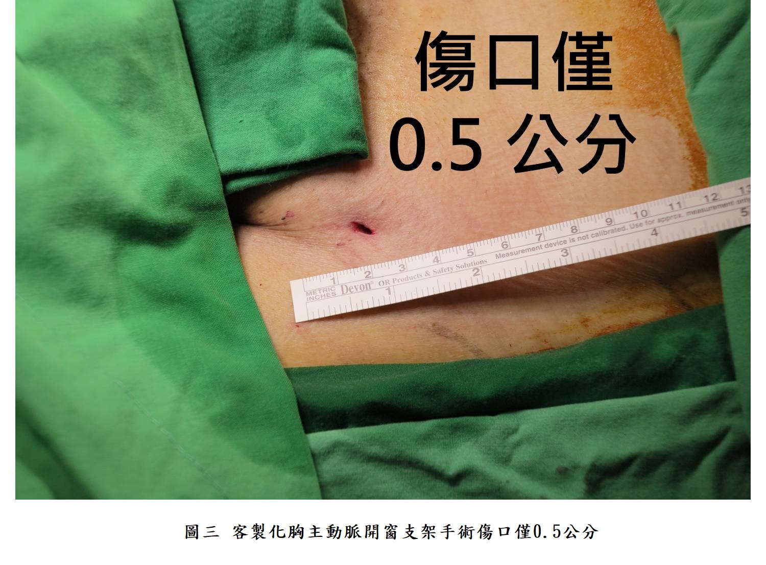 圖三 客製化胸主動脈開窗支架手術傷口僅0.5公分