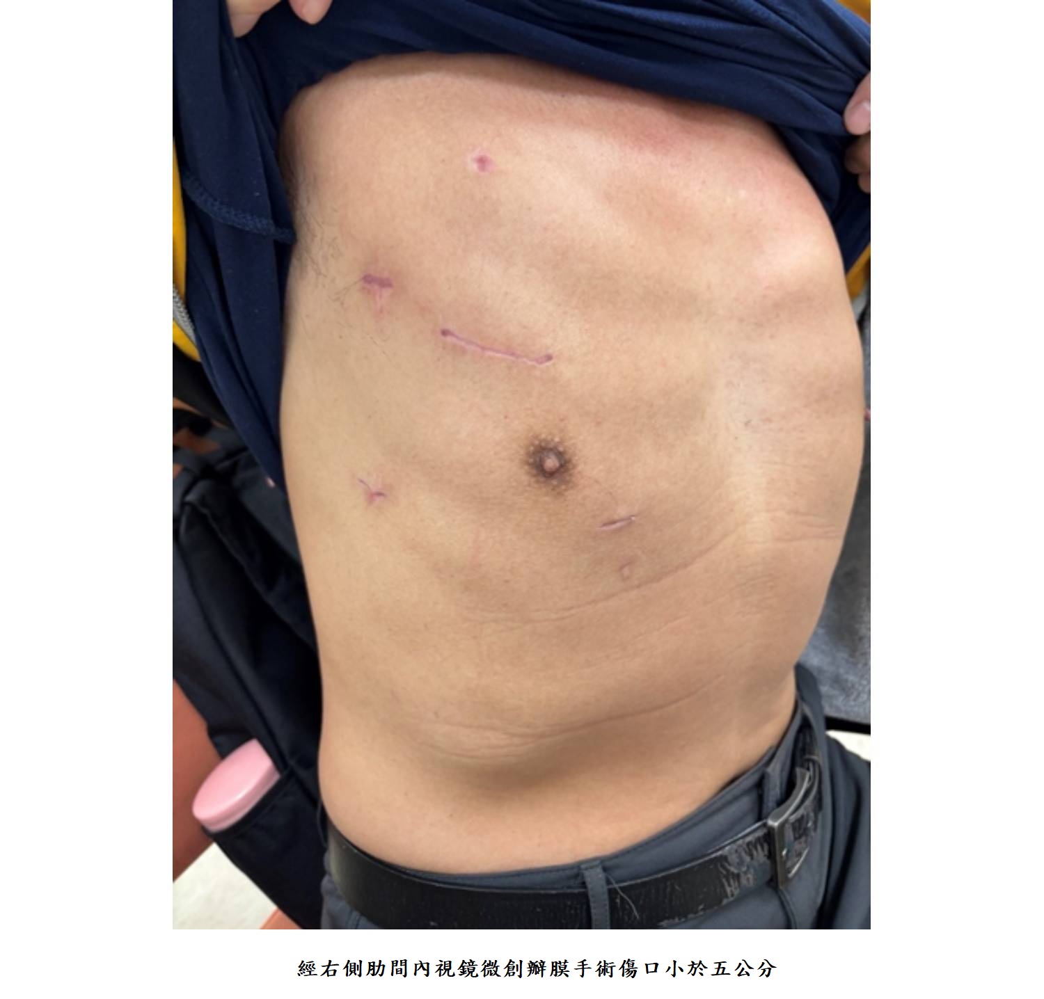 經右側肋間內視鏡微創瓣膜手術傷口小於五公分