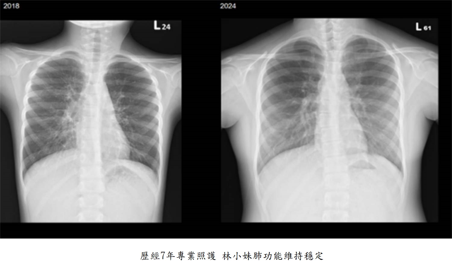 歷經7年專業照護 林小妹肺功能維持穩定