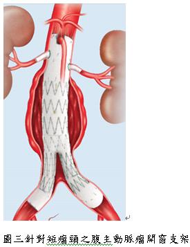 拆解胸腹主動脈瘤未爆彈的二大利器