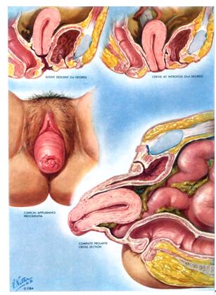 保留子宮  成功治療子宮嚴重脫垂