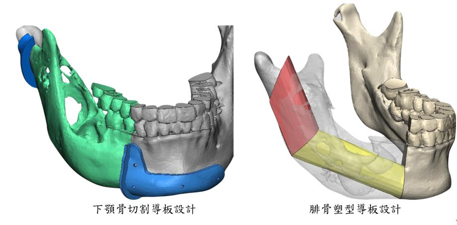 微創、導航、電腦輔助列印三合一  顎骨腫瘤切除重建不留疤