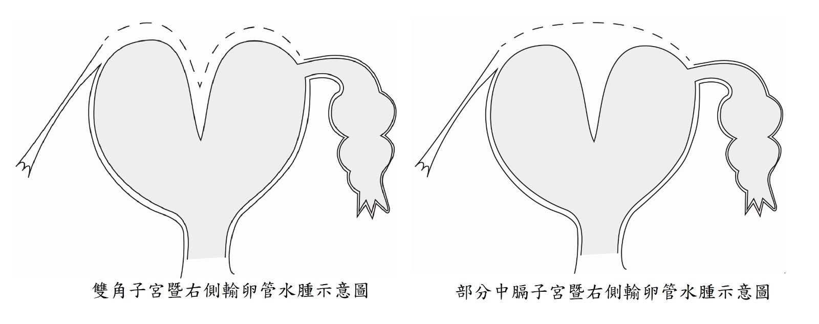 左圖為雙角子宮暨右側輸卵管水腫示意圖，右圖為部分中膈子宮暨右側輸卵管水腫示意圖