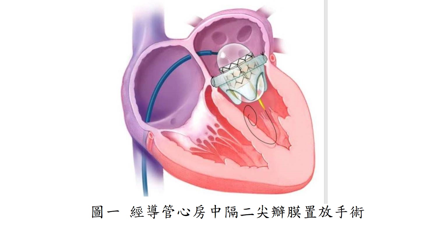 圖一 經導管心房中隔二尖瓣膜置放手術