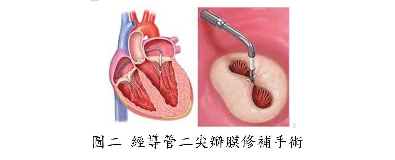 圖二 經導管二尖瓣膜修補手術