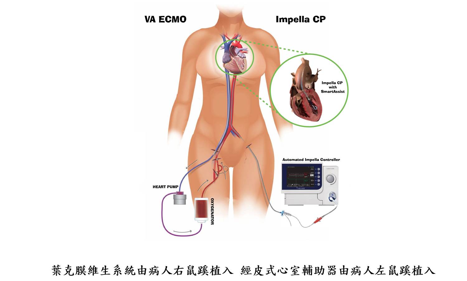 葉克膜維生系統由病人右鼠蹊植入 經皮式心室輔助器由病人左鼠蹊植入