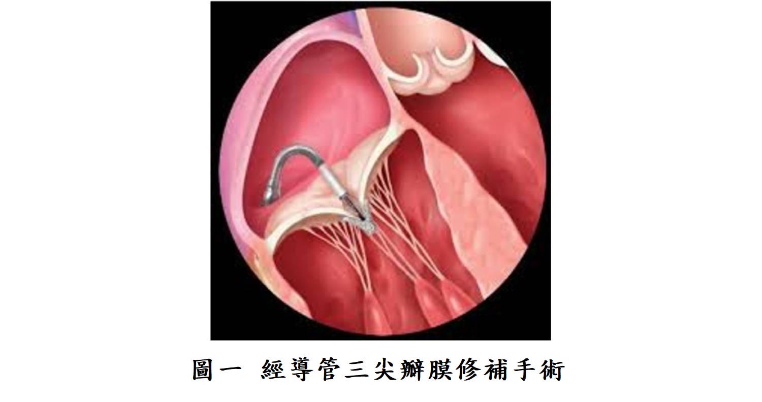 圖一 經導管三尖瓣膜修補手術