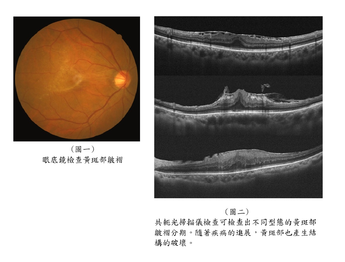(圖一) 眼底鏡檢查黃斑部皺褶 (圖二) 共軛光掃描儀檢查可檢查出不同型態的黃斑部 皺褶分期。隨著疾病的進展,黃斑部也產生結 構的破壞。
