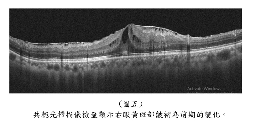 (圖五) 共軛光掃描儀檢查顯示右眼黃斑部皺褶為前期的變化。
