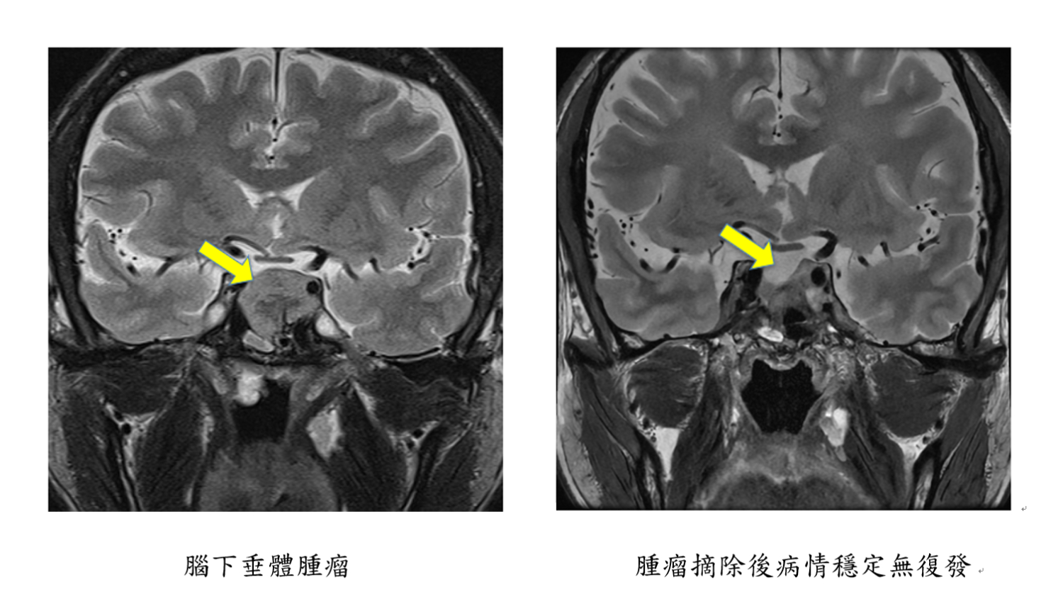 腦下垂體腫瘤 (左圖) & 腫瘤摘除後病情穩定無復發 (右圖)