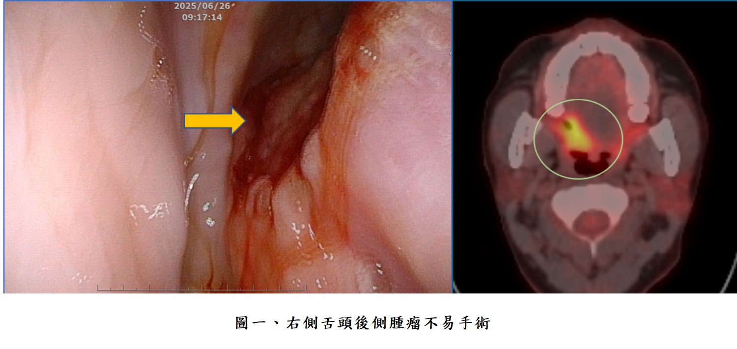 圖一、右側舌頭後側腫瘤不易手術