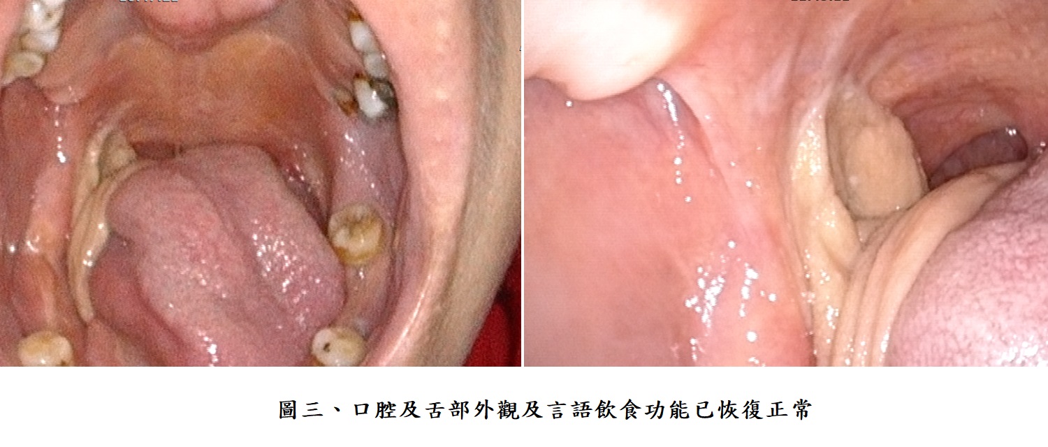 圖三、口腔及舌部外觀及言語飲食功能已恢復正常