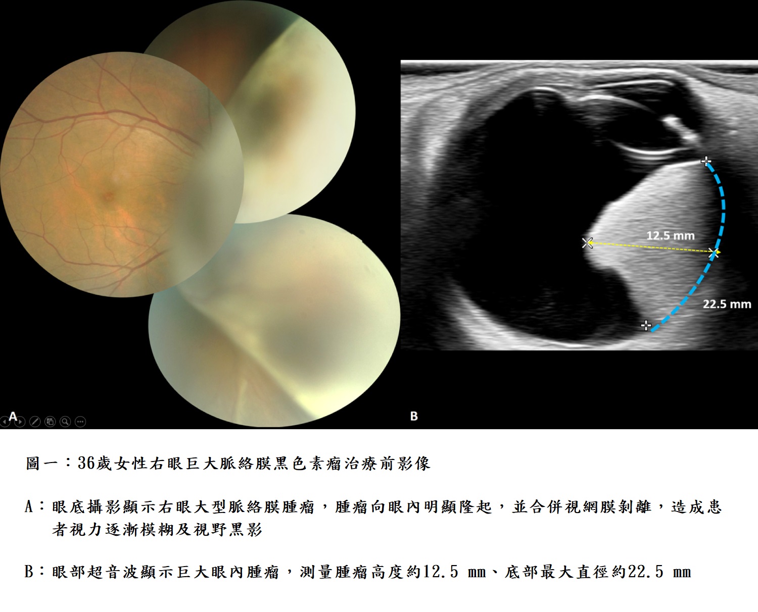圖一:36歲女性右眼巨大脈絡膜黑色素瘤治療前影像。 A: 眼底攝影顯示右眼大型脈絡膜腫瘤,腫瘤向眼內明顯隆起,並合併視網膜剝離,造成患者視力逐漸模糊及視野黑影。 B: 眼部超音波顯示巨大眼內腫瘤,測量腫瘤高度約12.5 mm、底部最大直徑約22.5 mm。