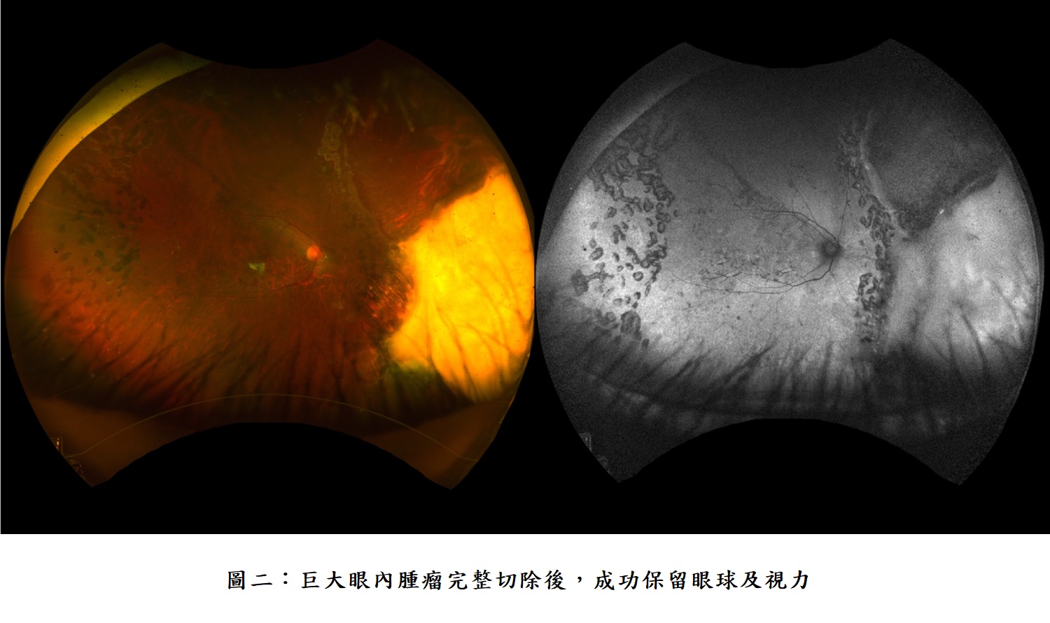 圖二:巨大眼內腫瘤完整切除後,成功保留眼球及視力。