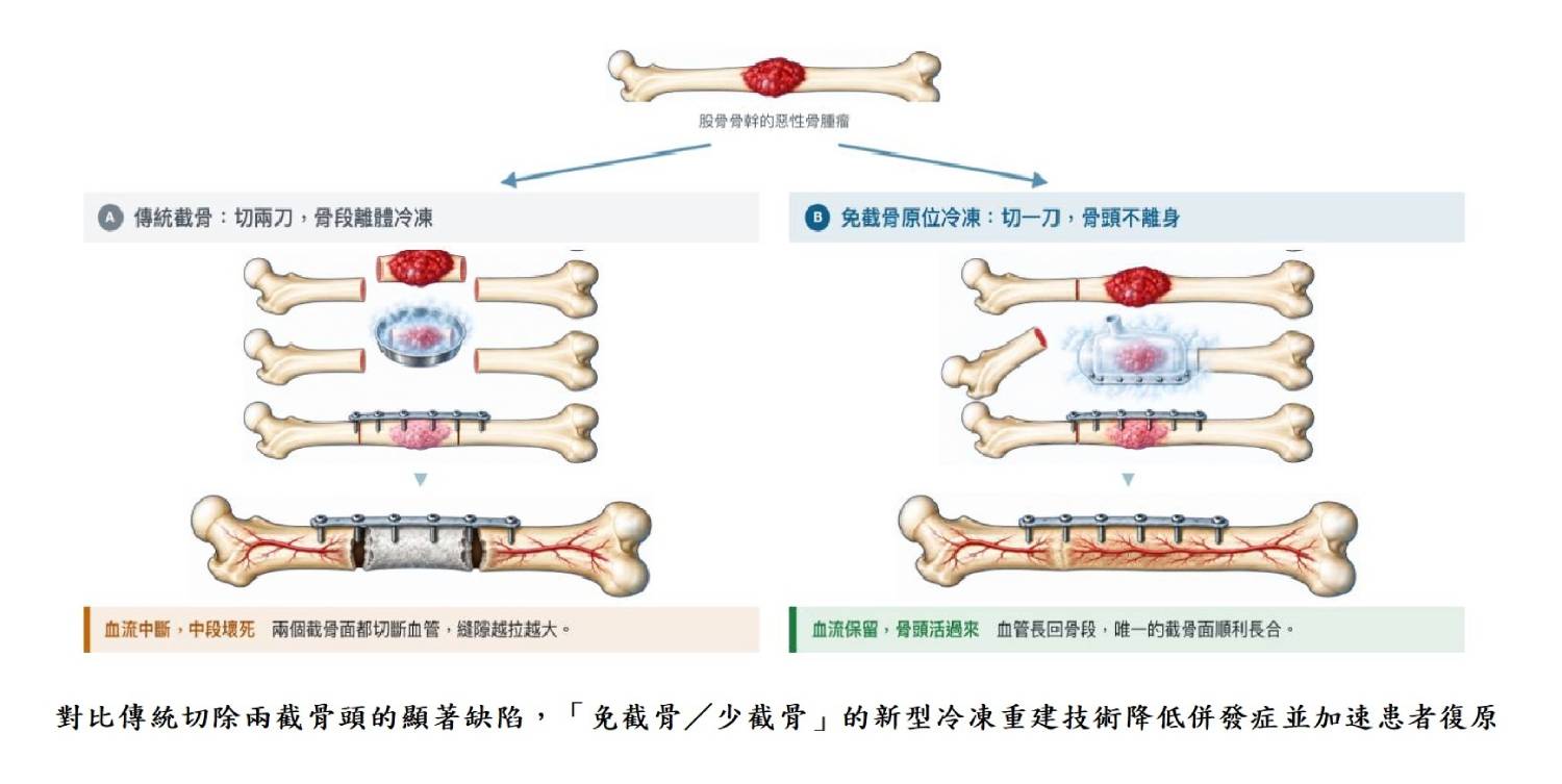 對比傳統切除兩截骨頭的顯著缺陷,「免截骨/少截骨」的新型冷凍重建技術降低併發症並加速患者復原
