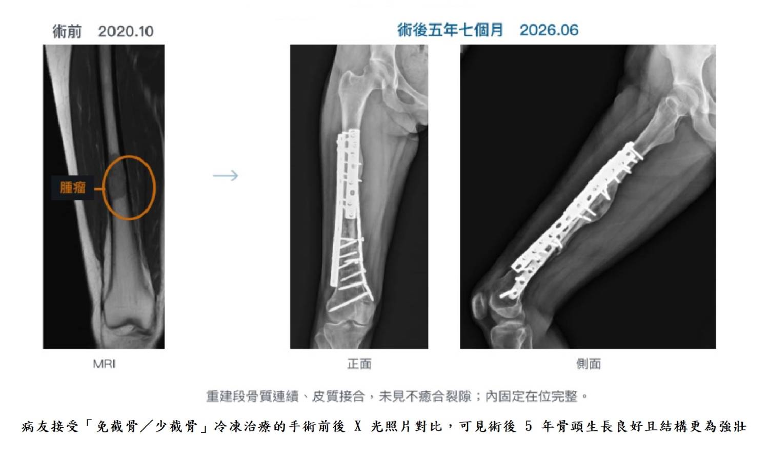 病友接受「免截骨/少截骨」冷凍治療的手術前後 X 光照片對比,可見術後 5 年骨頭生長良好且結構更為強壯